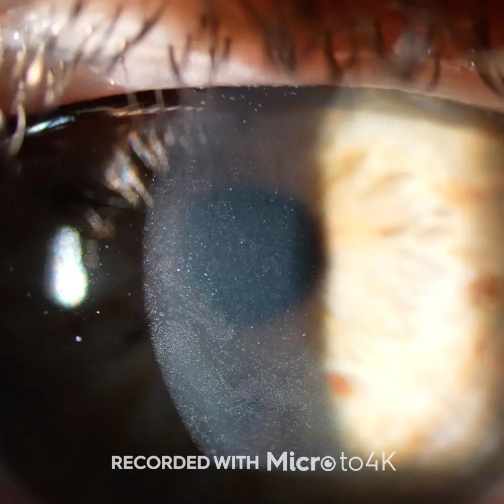 Close-up image of a human eye captured through a slit lamp, showing detailed texture and clarity of the cornea and iris. The image includes reflections of light and fine eyelashes, with the text "RECORDED WITH Microto4K" displayed at the bottom.