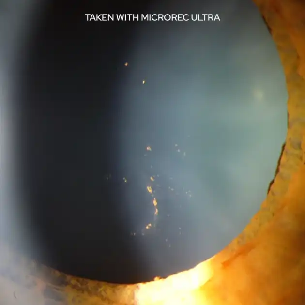 Anterior eye image captured with MicroREC Ultra under low-light conditions