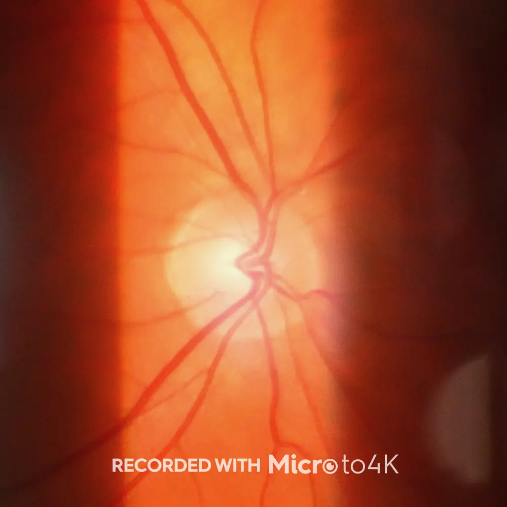 Close-up image of the human retina captured through a slit lamp, showing detailed blood vessels radiating from the optic disc in vivid red and orange tones. A bright reflection of light is present near the center, with the text "RECORDED WITH Microto4K" displayed at the bottom.