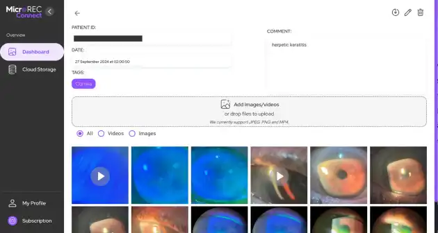 Series of slit lamp images showing keratitis progression over time